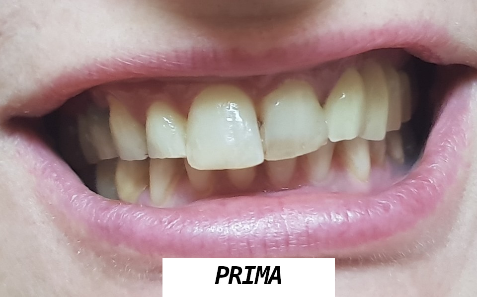 Rekonstrukcja łuku dolnego oraz łuku górnego przed