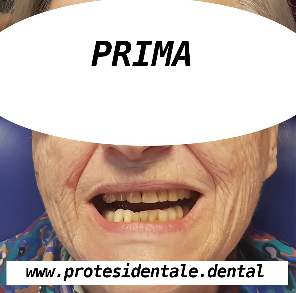 Mosty porcelanowe na zębach własnych przed