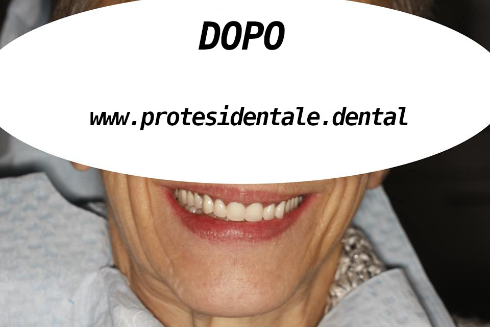szczęka: proteza na lokatorach; żuchwa: korony porcelanowe + proteza na zasuwach po 1