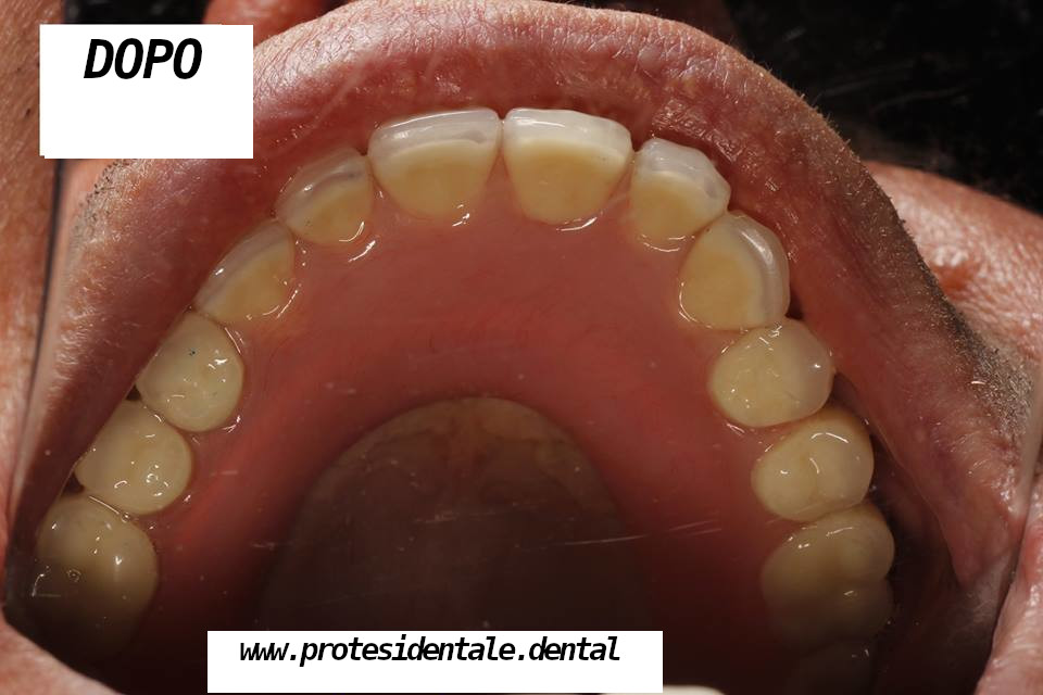 szczęka: proteza na lokatorach; żuchwa: korony porcelanowe na zębach własnych i implantach po 2