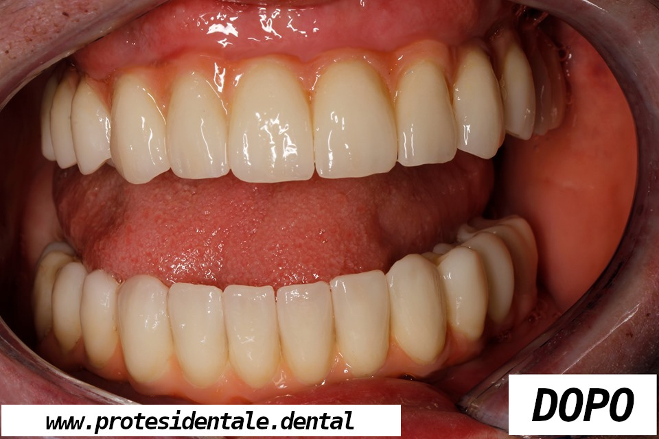 mosty porcelanowe na cyrkonie, na implantach po 1