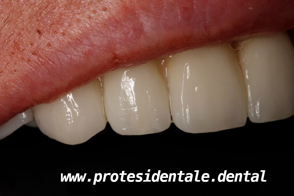 mosty porcelanowe na cyrkonie, na implantach po 2