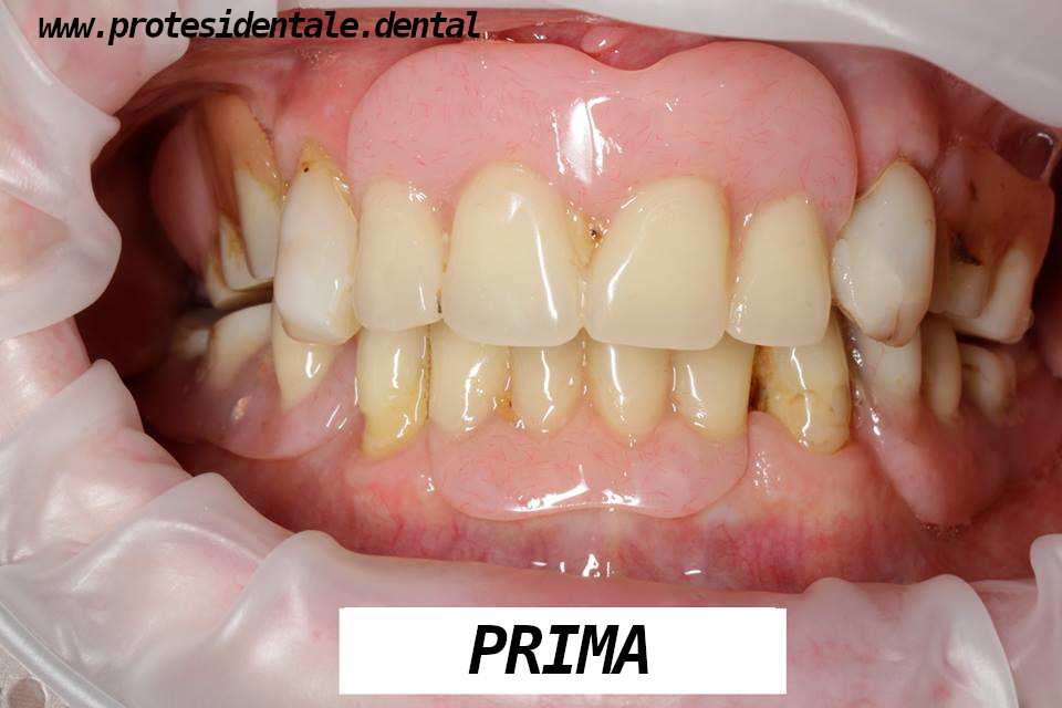 mosty porcelanowe, na cyrkonie, na implantach przed