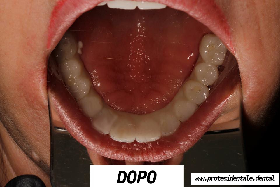 mosty porcelanowe, na cyrkonie, na implantach po 2