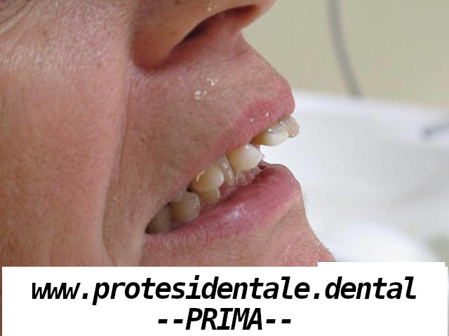 Kamuflaż protetyczny przed