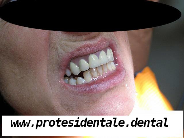Kamuflaż protetyczny po 2
